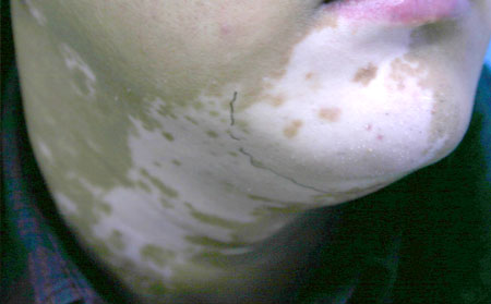 治療白癜風(fēng),白癜風(fēng)治療方法,白癜風(fēng)常識(shí)