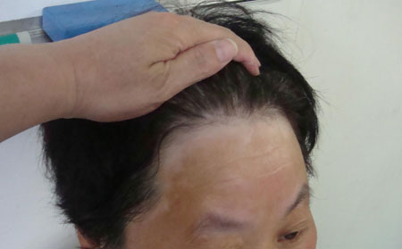 治療白癜風(fēng),治療白癜風(fēng)的醫(yī)院,白癜風(fēng)飲食