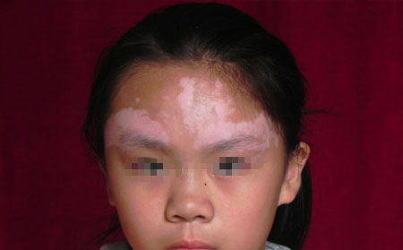 白癜風(fēng)傳染嗎,白癜風(fēng)會(huì)不會(huì)傳染,白癜風(fēng)傳染么