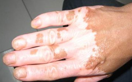 誘發(fā)白癜風(fēng)的原因,治療白癜風(fēng)