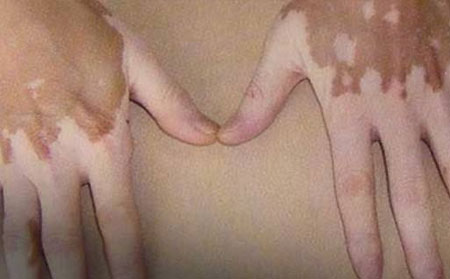 白癜風(fēng)病因,白癜風(fēng)的病因,濰坊銀康皮膚病醫(yī)院