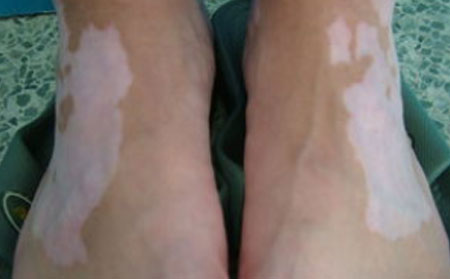 節(jié)段型白癜風(fēng),治療節(jié)段型白癜風(fēng),治療白癜風(fēng),白癜風(fēng)如何治療