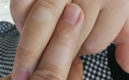 治療白癜風(fēng),治療白癜風(fēng)好,白癜風(fēng)用什么藥