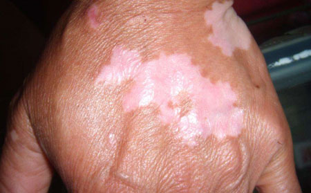 預(yù)防白癜風(fēng),怎么預(yù)防白癜風(fēng),預(yù)防白癜風(fēng)方法