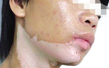 鑒別白癜風(fēng),如何區(qū)分白癜風(fēng),白癜風(fēng)癥狀表現(xiàn),白癜風(fēng)圖片