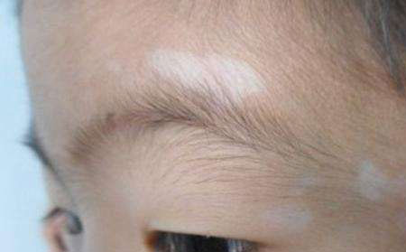 白癜風(fēng)飲食,白癜風(fēng)飲食禁忌,白癜風(fēng)飲食吃什么好