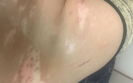 白癜風(fēng)預(yù)防護(hù)理,治療白癜風(fēng),山東省皮膚病醫(yī)院,濰坊銀康白癜風(fēng)醫(yī)院