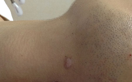 診斷白癜風(fēng),女性白癜風(fēng),診斷女性白癜風(fēng)