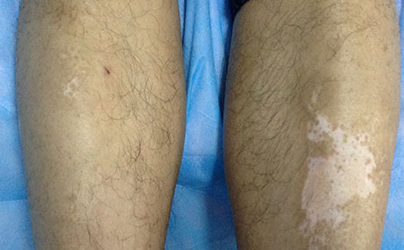 預(yù)防白癜風(fēng),兒童白癜風(fēng),預(yù)防兒童白癜風(fēng)