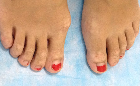 早期白癜風(fēng)癥狀,白癜風(fēng)用什么藥,治療白癜風(fēng)效果怎么樣