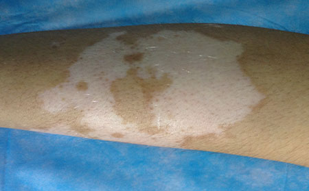 早期白癜風(fēng),白癜風(fēng)癥狀表現(xiàn),早期白癜風(fēng)癥狀