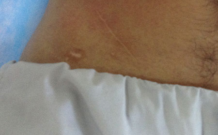 早期白癜風(fēng),白癜風(fēng)的治療,早期白癜風(fēng)治療