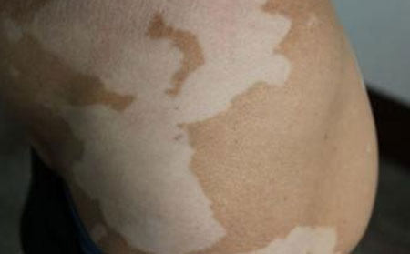 治療白癜風(fēng),治療白癜風(fēng)多少錢,治療白癜風(fēng)醫(yī)院