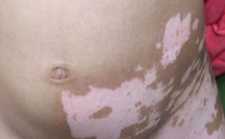 預(yù)防白癜風(fēng),怎么預(yù)防白癜風(fēng),白癜風(fēng)預(yù)防方法