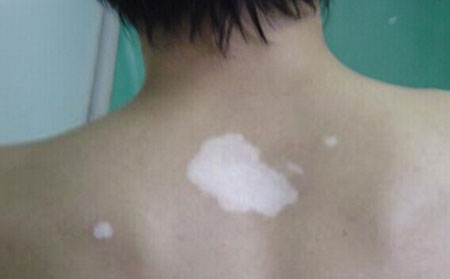 女性白癜風(fēng),孕婦白癜風(fēng),白癜風(fēng)預(yù)防護(hù)理