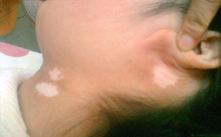 預(yù)防白癜風(fēng),如何做好白癜風(fēng)預(yù)防