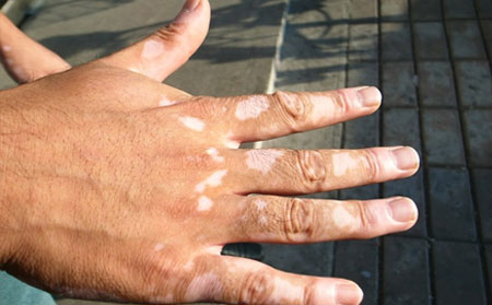 預防白癜風,預防白癜風發(fā)作,濰坊白癜風醫(yī)院