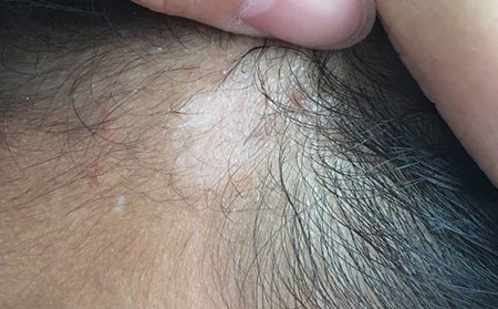 白癜風(fēng)發(fā)病原因,白癜風(fēng)病因,誘發(fā)白癜風(fēng)的原因