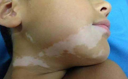 白癜風發(fā)病原因,白癜風病因,誘發(fā)白癜風病因