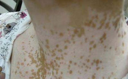 白癜風發(fā)病原因,白癜風病因,誘發(fā)白癜風病因