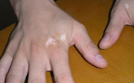 白癜風(fēng)發(fā)病原因,白癜風(fēng)病因,濰坊白癜風(fēng)醫(yī)院