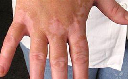 白癜風(fēng)發(fā)病原因,白癜風(fēng)病因,導(dǎo)致白癜風(fēng)的外在原因