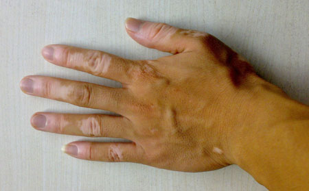 白癜風(fēng)發(fā)病原因,白癜風(fēng)病因,誘發(fā)白癜風(fēng)