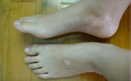 白癜風(fēng)預(yù)防,預(yù)防白癜風(fēng)方法,濰坊白癜風(fēng)醫(yī)院