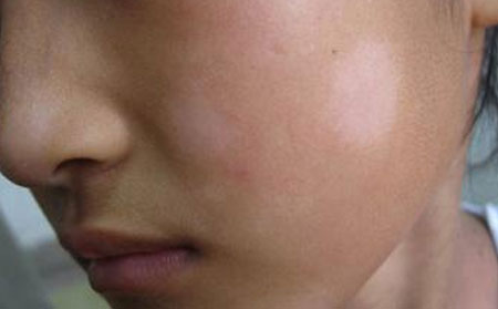 治療白癜風(fēng),白癜風(fēng)治療效果,治療白癜風(fēng)醫(yī)院