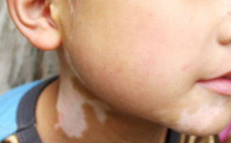 白癜風(fēng)怎么治療,治療嬰兒白癜風(fēng),治療臉上白癜風(fēng)