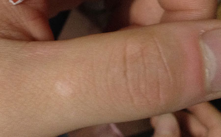 白癜風(fēng)治不好,白癜風(fēng)治療,濰坊白癜風(fēng)醫(yī)院