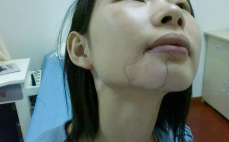 白癜風(fēng)發(fā)病原因,白癜風(fēng)癥狀,耳朵白癜風(fēng)癥狀圖片