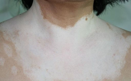 白癜風(fēng)治療,治療白癜風(fēng)藥物,白癜風(fēng)外用藥