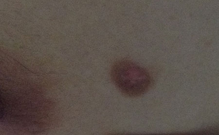 白癜風(fēng)發(fā)病原因,引起白癜風(fēng)的病因