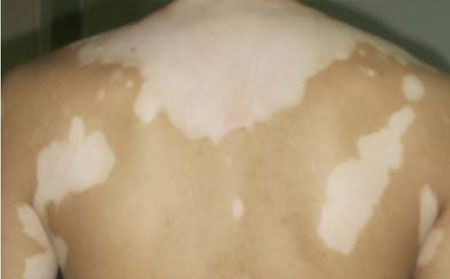 治療白癜風(fēng),白癜風(fēng)激光治療,白癜風(fēng)UVB,白癜風(fēng)照光