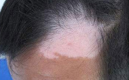 治療白癜風,藥物治療白癜風,濰坊治療白癜風醫(yī)院