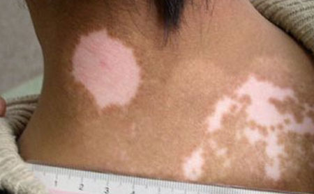 白癜風怎么區(qū)別,汗斑