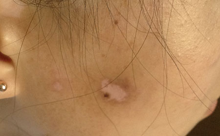 白癜風(fēng)危害有哪些,小兒白癜風(fēng)危害,兒童白癜風(fēng)危害