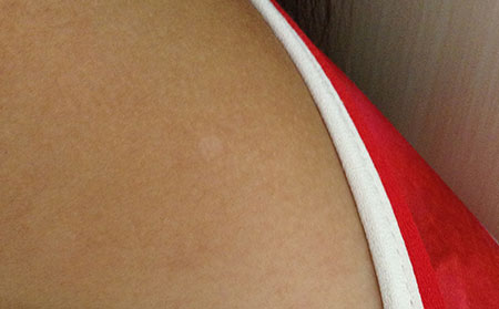 秋季白癜風(fēng),秋季治療白癜風(fēng)