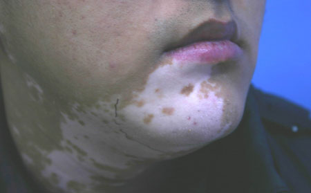 白癜風(fēng)不好治,治療白癜風(fēng)