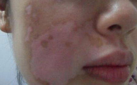 白癜風發(fā)病率,女性白癜風,男性白癜風