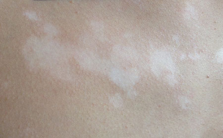 白癜風發(fā)病原因,導致白癜的病因,微量元素缺乏