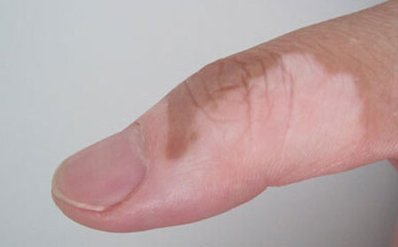 頭部白癜風(fēng),白癜風(fēng)辨別