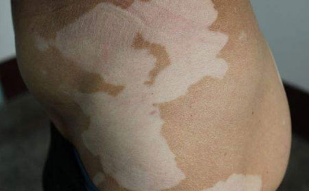 頭部白癜風(fēng),白癜風(fēng)的危害有哪些