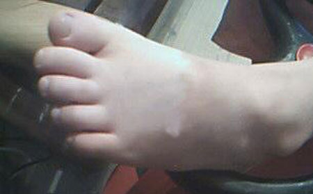 白癜風(fēng)發(fā)病原因,白癜風(fēng)病因有哪些