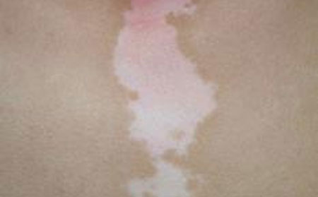 白癜風癥狀,手部白癜風,白斑發(fā)病原因