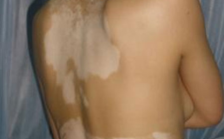 白癜風(fēng)發(fā)病原因,手部白癜風(fēng)癥狀