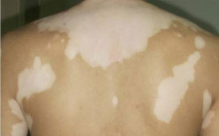 適合白癜風患者的生活習慣是怎么樣的