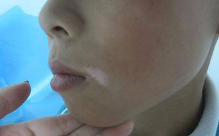 冬季白癜風,治療白癜風比較好
