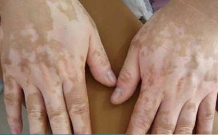 白癜風(fēng)發(fā)病原因,什么原因誘發(fā)白癜風(fēng)